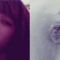 Juicypussy2288's face and her anal prolapse from m...
